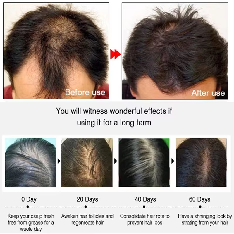 빠른 생강 모발 성장 스프레이, 모발 뿌리 강화, 탈모 - Growth Factor Serum 리뷰 및 가격